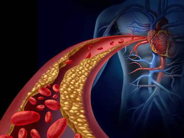 Zator tętnic mózgu- czy jest niebezpieczny?