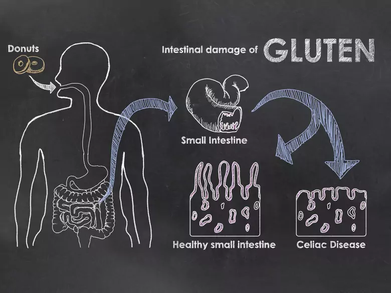 Korelacja pomiędzy glutenem a migreną. Czy to możliwe?