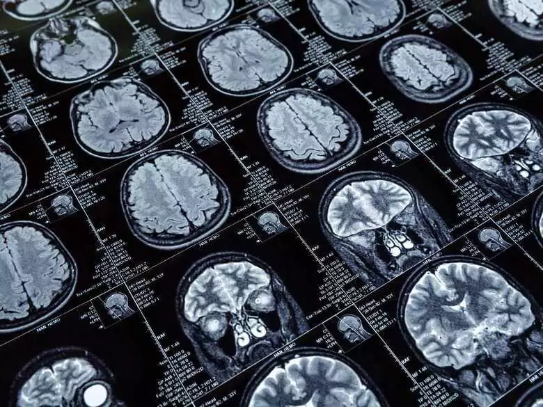 Najczęściej występujące następstwa udaru niedokrwiennego mózgu