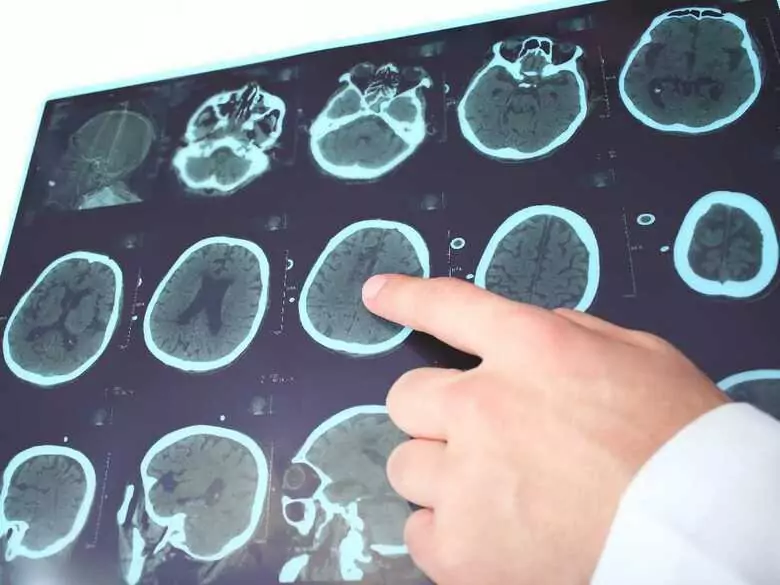 Paraplegie spastyczne – czym są?