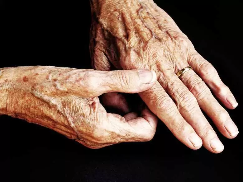 Radiosynowektomia: radioizotopy w leczeniu zapalenia stawów w przebiegu RZS i innych schorzeń